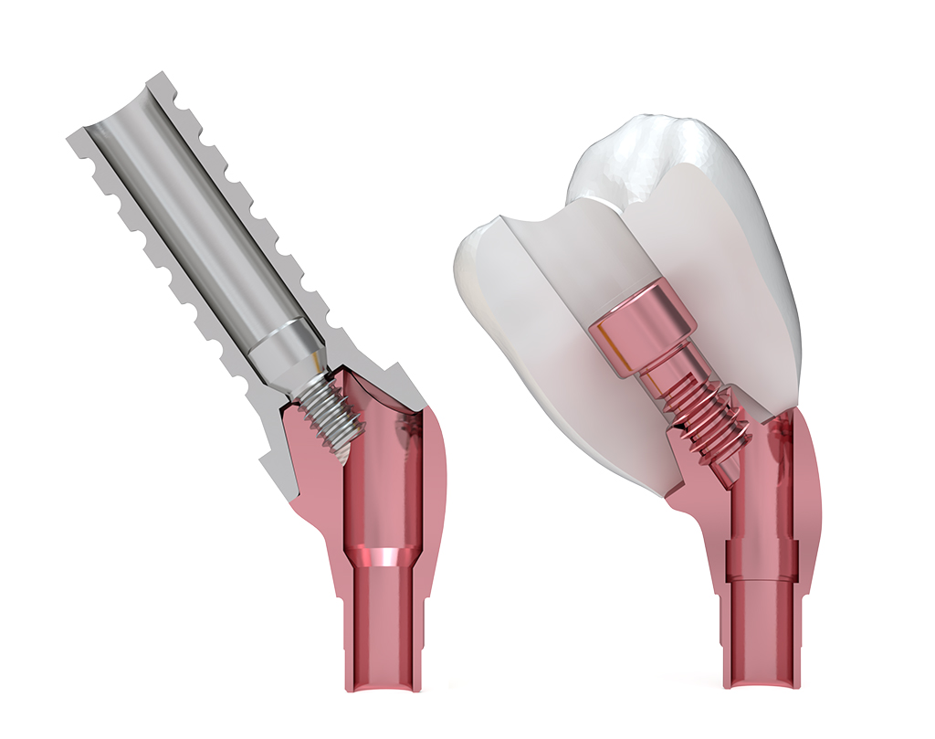 ICX-Ceramo Multi Flex Prothetikaufbau (PEEK)