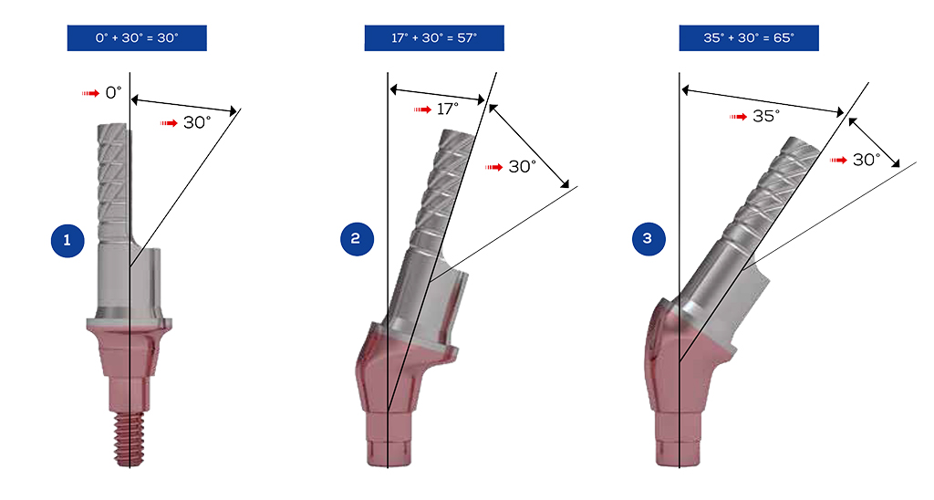 ICX-Ceramo Multi Flex Prothetikaufbau (PEEK)